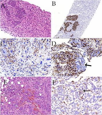 Osteoclasts in Tumor Biology: Metastasis and Epithelial-Mesenchymal-Myeloid Transition